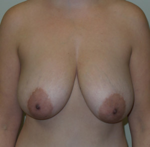 Breast Fat Grafting
