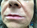 Volbella Lip Treatment