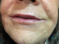 Volbella Lip Treatment