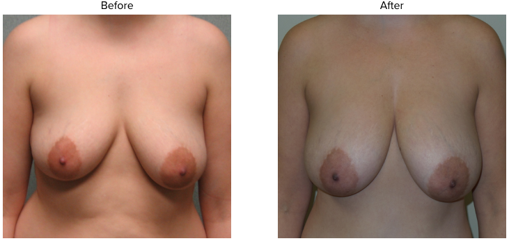 Breast Fat Grafting  Before and After